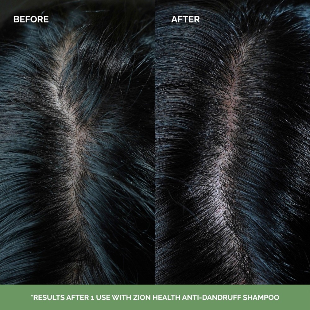 Zion Health Anti-Dandruff Shampoo 12oz image